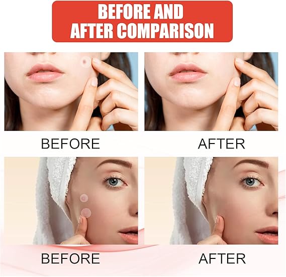 Skin Tag And Acne Remover Patch (144 Pcs) | مايكرو باتش بر