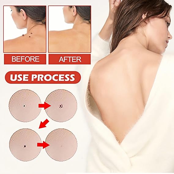 Skin Tag And Acne Remover Patch (144 Pcs) | مايكرو باتش بر