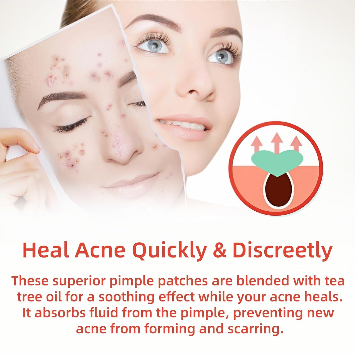Skin Tag And Acne Remover Patch (144 Pcs) | مايكرو باتش بر